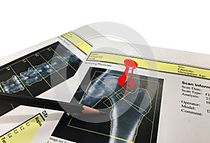 Hip and Spine Bone mineral density BMD DEXA densitometry hip scan. Osteopenia present, frequent precursor to osteoporosis