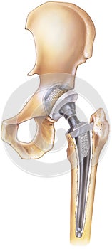 Hip - Total Replacement photo
