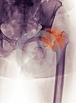 Hip x-ray, fracture and DJD (degenerative joint d) photo