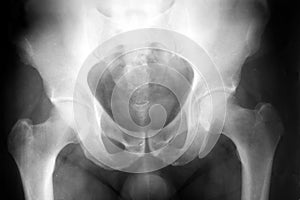 Hip xray photo