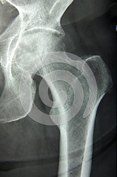 Hip xray, classic radiography