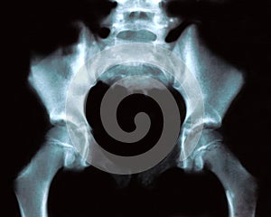 Hip Xray - front view