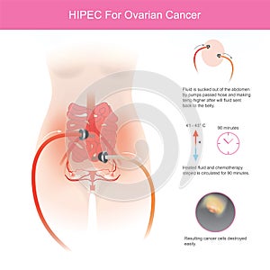 HIPEC For Ovarian Cancer. The use of chemotherapy to destroy ovarian cancer cells through fluid in the abdomen at higher photo
