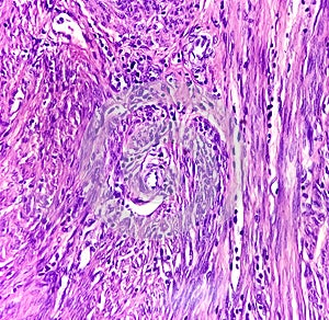 A histological slide of a tissue sample. Large cell lymphoma in the colonic mucosa