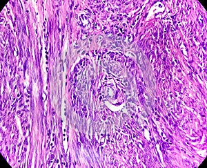 A histological slide of a tissue sample. Large cell lymphoma in the colonic mucosa