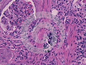 Histology of abnormal tissue (calcium) photo