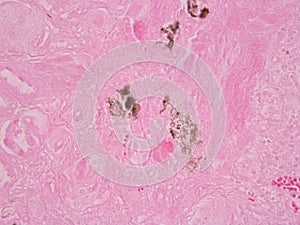 Histology of abnormal tissue (calcium)