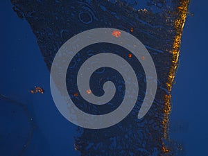 Histology of abnormal tissue (calcium) using polarization