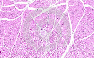 Histology of human tissue, show necrosis of skeletal muscle as seen under the microscope, 10x zoom
