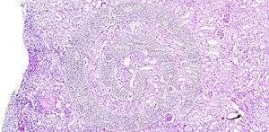 Histology of human tissue, show nephritis as seen under the microscope photo