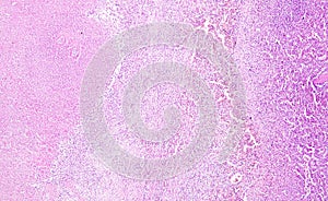 Histology of human tissue, show spleen infarction at a scarring stage as seen under the microscope photo