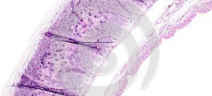 Histology of human tissue, show tracheitis as seen under the microscope