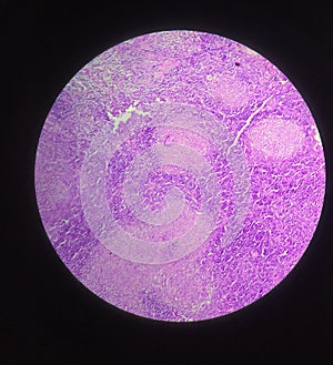 Histology slide  of lymphadenitis photo