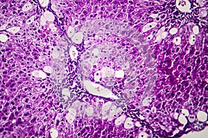 Histopathology of acute hepatitis