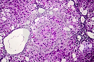 Histopathology of acute hepatitis