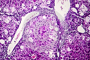 Histopathology of acute hepatitis photo