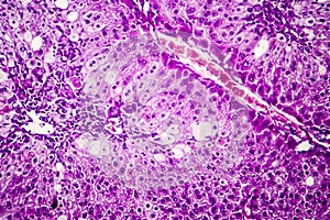 Histopathology of acute hepatitis photo