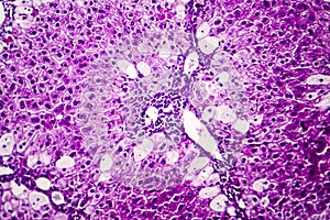 Histopathology of acute hepatitis