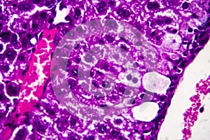 Histopathology of acute hepatitis photo