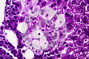 Histopathology of acute hepatitis photo