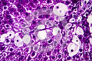 Histopathology of acute hepatitis photo