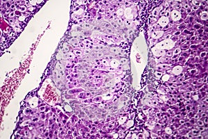 Histopathology of acute hepatitis