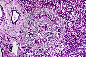 Histopathology of biliary cirrhosis