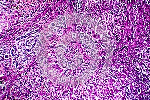 Histopathology of biliary cirrhosis