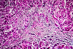 Histopathology of biliary cirrhosis