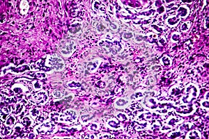 Histopathology of biliary cirrhosis