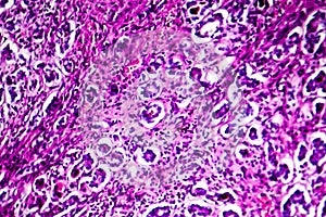 Histopathology of biliary cirrhosis