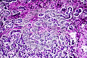 Histopathology of biliary cirrhosis