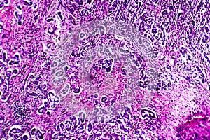 Histopathology of biliary cirrhosis photo