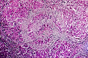 Histopathology of biliary cirrhosis photo