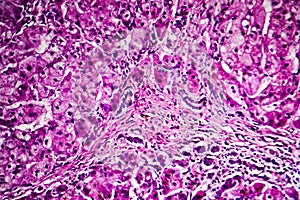 Histopathology of biliary cirrhosis photo