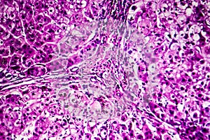 Histopathology of biliary cirrhosis photo