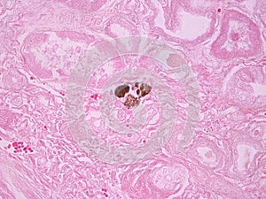 Histopathology of Calcium Deposits in Human Kidney