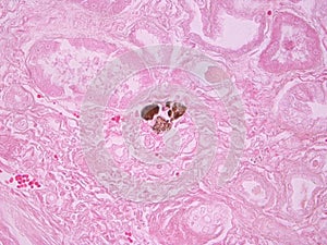 Histopathology of Calcium Deposits in Human Kidney photo