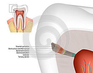 Histopathology of Caries in Enamel and Dentine. Enamel Dentin Pulp complex. Diagram. Tertiary dentine