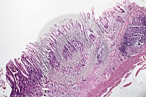 Chronic atrophic gastritis, light micrograph