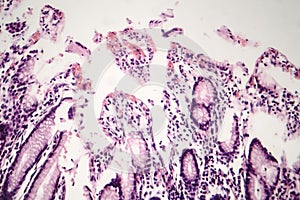 Chronic atrophic gastritis, light micrograph