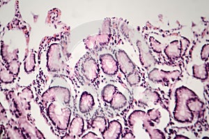 Chronic atrophic gastritis, light micrograph