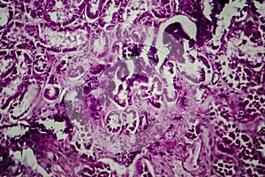 Diffuse sclerosing glomerulonephritis