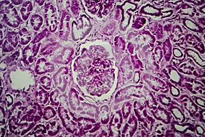 Diffuse sclerosing glomerulonephritis