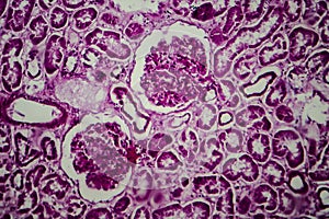 Diffuse sclerosing glomerulonephritis