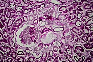 Diffuse sclerosing glomerulonephritis
