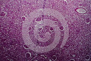 Diffuse sclerosing glomerulonephritis