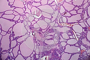 Histopathology of Endemic goitre