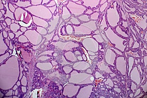 Histopathology of Endemic goitre