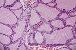 Histopathology of Endemic goitre